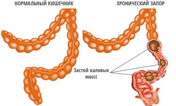Может ли запор вызывать боли в спине