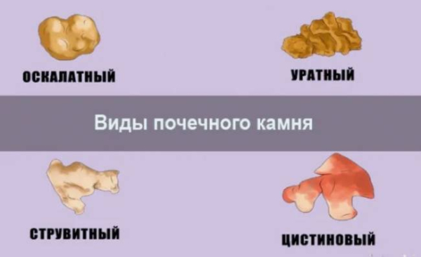 Пищевые привычки и камни в почках