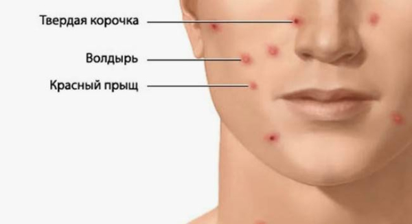 Что такое ветряная оспа
