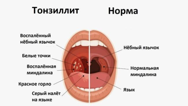 Следует ли использовать антибиотики при ангине Следует ли использовать антибиотики при ангине