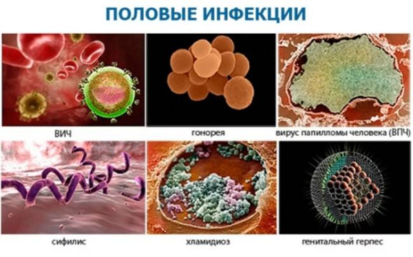 Симптомы заболеваний, передающихся половым путем
