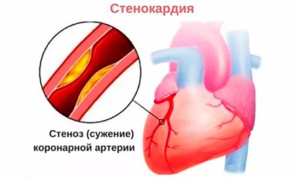 Эффективность и безопасность атенолола при лечении гипертонии и стенокардии Эффективность и безопасность атенолола при лечении гипертонии и стенокардии