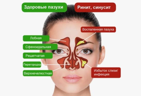 Как отличить насморк от инфекции пазух носа Как отличить насморк от инфекции пазух носа